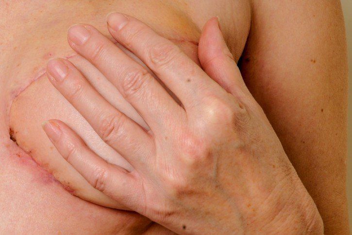 Rehabilitacja po mastektomii